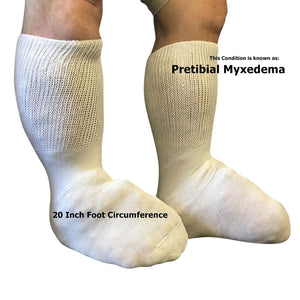 Beyond Extra Wide Bariatric Socks - Pretibial Myxedema