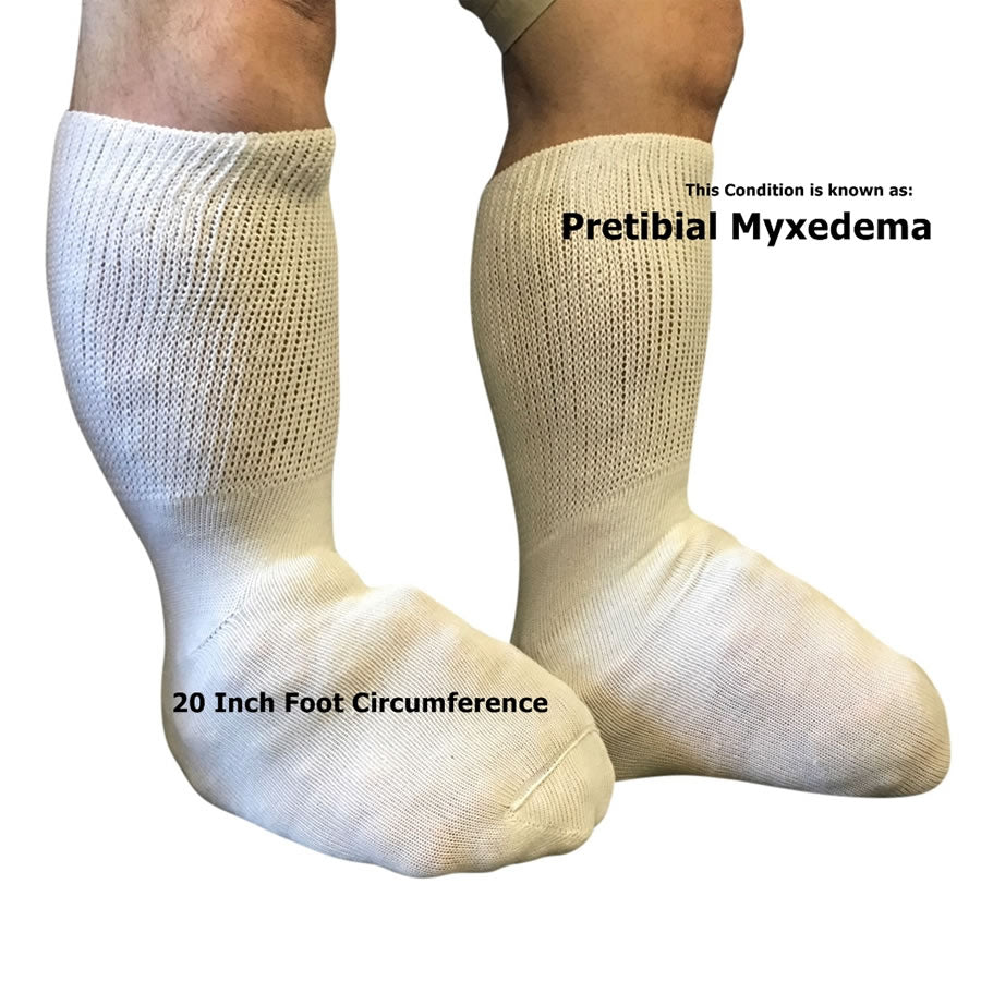 Beyond Extra Wide Bariatric Socks - Pretibial Myxedema